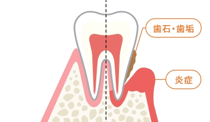 歯周炎・歯肉炎