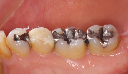 被せ物・詰め物の不具合