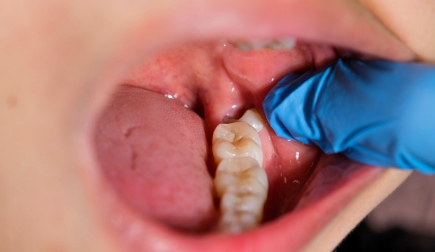 親知らずやその周辺の炎症