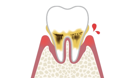 進行した歯周病
