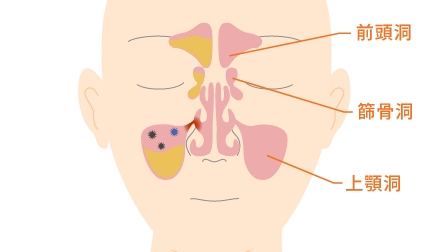 上顎洞炎（副鼻腔炎）