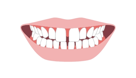 すきっ歯・空隙歯列
