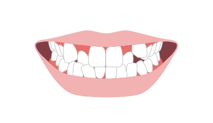 八重歯・叢生（そうせい）・乱杭歯