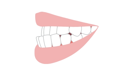 受け口（反対咬合）・しゃくれ