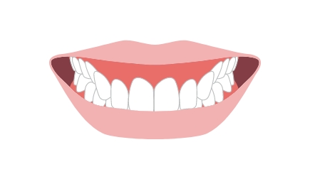 嚙み合わせが深い過蓋咬合（ディープバイト）