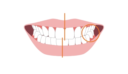 交叉咬合（クロスバイト）