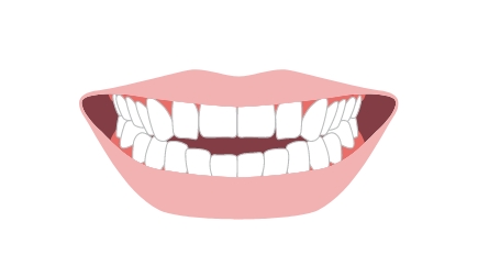 開咬（オープンバイト）