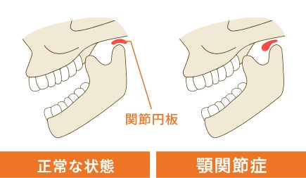 顎関節症