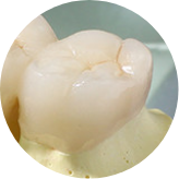 オールセラミック（e-max）