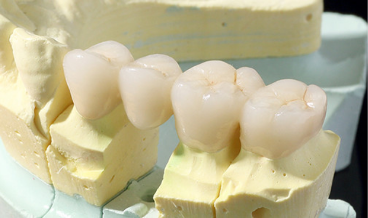 オールセラミック(e-max)