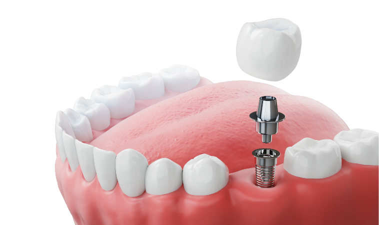 インプラント治療とは