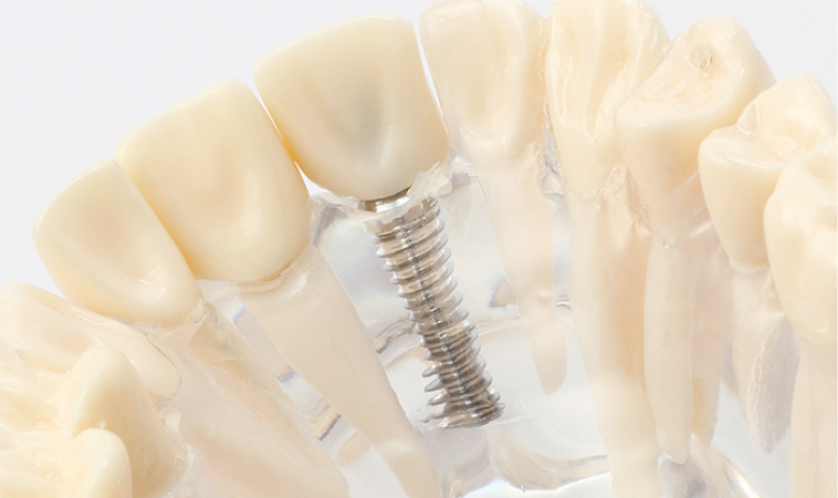 インプラント