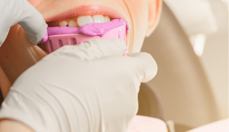 仮歯（人工歯）の歯型取り・作製・装着