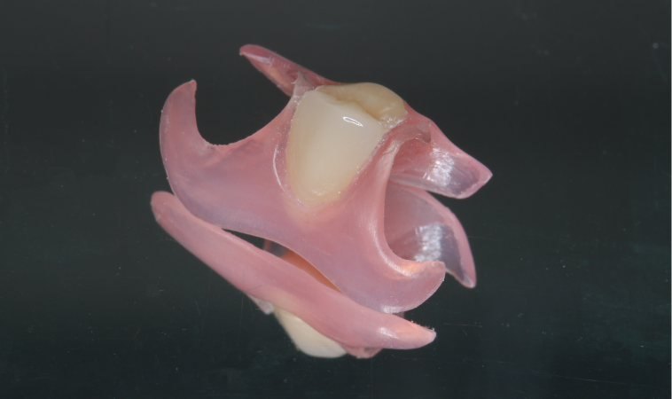 金属不使用で目立たない入れ歯「ノンクラスプデンチャー」