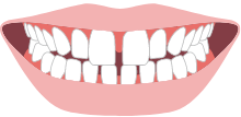 すきっ歯・空隙歯列