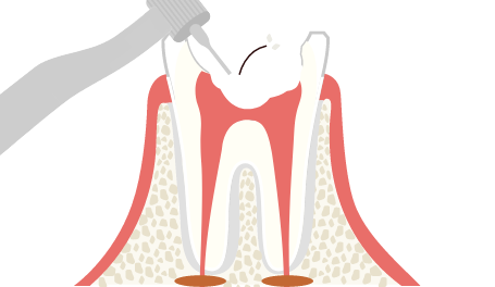 むし歯除去(虫歯除去)
