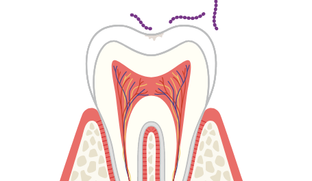 C0のむし歯の症状・治療法