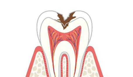 C2のむし歯の症状・治療法