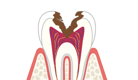 C3のむし歯の症状・治療法