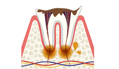 C4のむし歯の症状・治療法