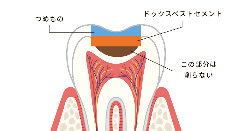 ドックスベストセメント