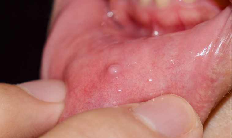 口内の嚢胞（のうほう）