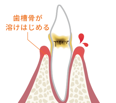 歯周炎（軽度）