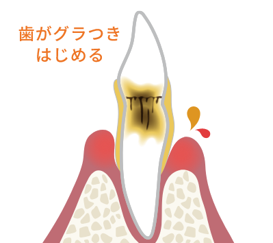 歯周炎（中度）