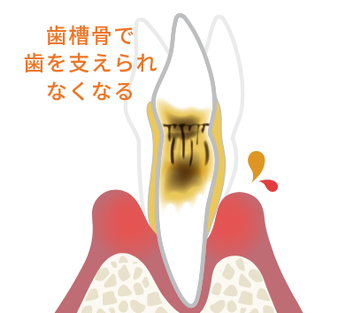 歯周炎（重度）
