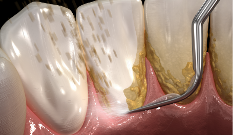 歯石取りと歯周病菌の除菌