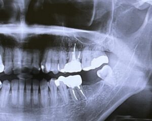 歯をぶつけた！！外傷歯の治療について